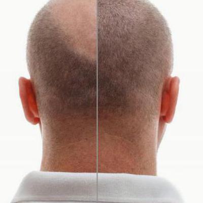 Jak dbać o skórę głowy po przeszczepie włosów?